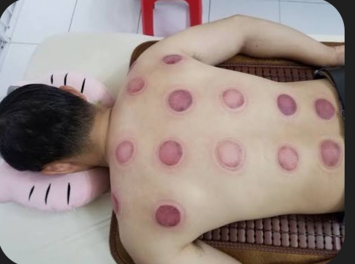 Cạo gió ,giác hơi - 2