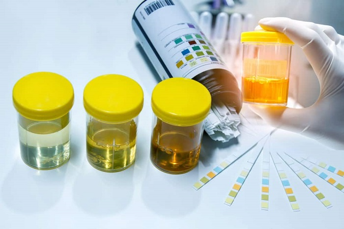 Xét nghiệm nước tiểu toàn phần